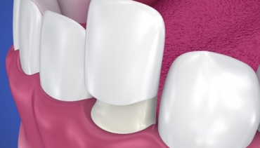 Aesthetic dentistry – whitening, facets, bonding