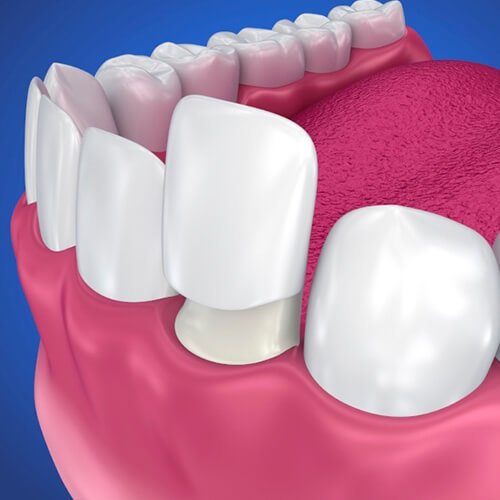 Aesthetic dentistry – whitening, facets, bonding
